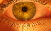 Bloodshot EyeBall