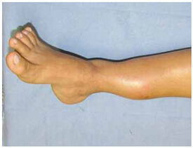 Osteossarcoma 3